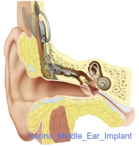 Carina_Middle_Ear_Implant Carina_Middle_Ear_Implant