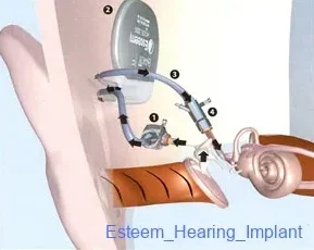 Esteem_Hearing_Implant Esteem_Hearing_Implant