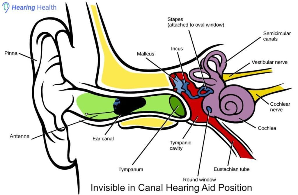 Invisible-in-Canal_Hearing_Aid