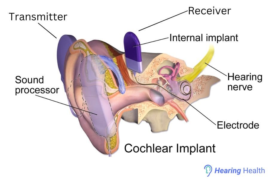 cochlear_implant